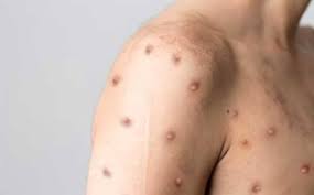 (ESTADOS UNIDOS) DECLARAN EMERGENCIA SANITARIA POR VIRUELA DEL MONO